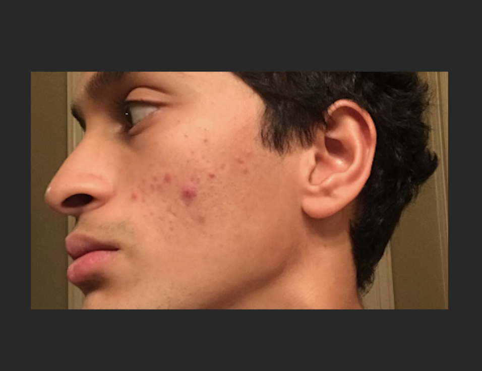 Acne Analysis image